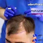 کاشت مو درد دارد + نکات بعد از کاشت