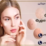 بهترین درمان لک های صورت + عوامل ایجاد لک های پوستی