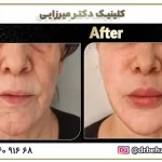 اقدامات تزریق چربی | توصیه ها و مراقبت های قبل و بعد از تزریق چربی