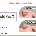 بهترین مرکز تزریق فیلر بینی در فردیس (زیبایی بینی بدون جراحی)