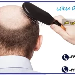 طاسی سر ؛ علت طلاسی سر و درمان | کلینیک دکتر میرزایی