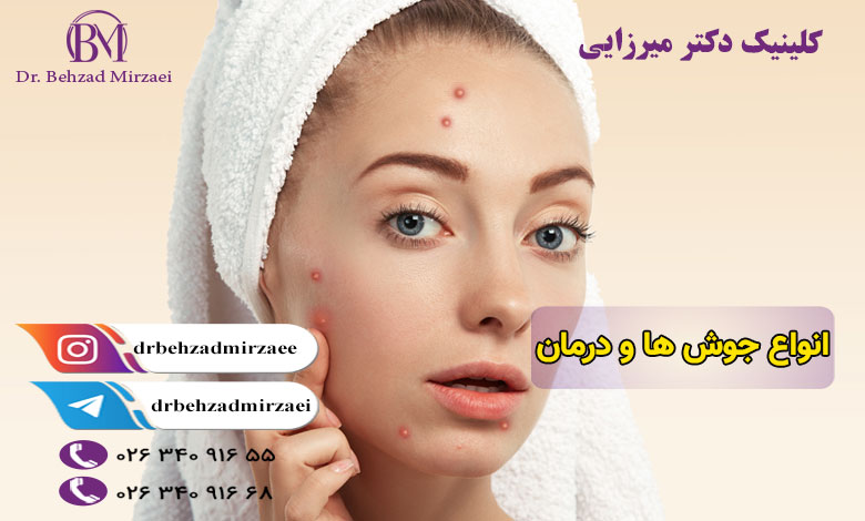 چرا جوش‌ها به وجود می‌آیند؟ و درمان جوش ها