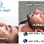 لیفت بینی در فردیس