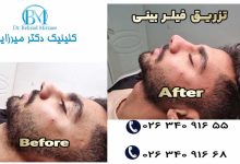 تزریق فیلر بینی در فردیس