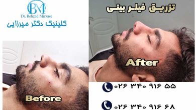 لیفت بینی در فردیس 6 تزریق فیلر بینی در فردیس