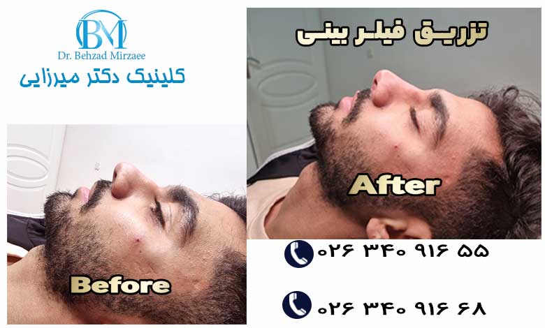 تزریق فیلر بینی