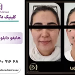 بهترین دستگاه هایفوتراپی 1405 (هایفو 7بعدی)