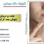 علت جوش بعد از لیزر موهای زائد+پیشگیری و درمان
