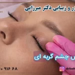 همه چیز درباره تزریق بوتاکس چشم گربه ای