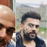 کلینیک کاشت مو طبیعی در فردیس کرج