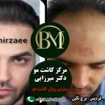 بهترین کلینیک کاشت مو در کرج | کاشت مو سال 1405 با تخفیف