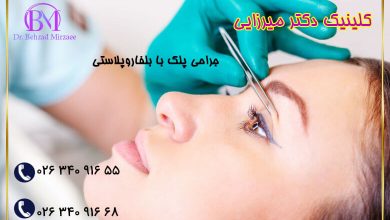 باید و نبایدهای عمل بلفاروپلاستی 1 نقاهت بعد از عمل بلفاروپلاستی