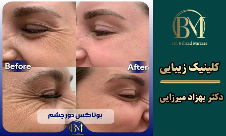 بهترین مرکز بوتاکس فردیس کرج ⭐【سال1404】 3 تزریق بوتاکس دور چشم در فردیس