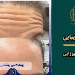 بهترین مرکز بوتاکس فردیس کرج ⭐【سال1405】