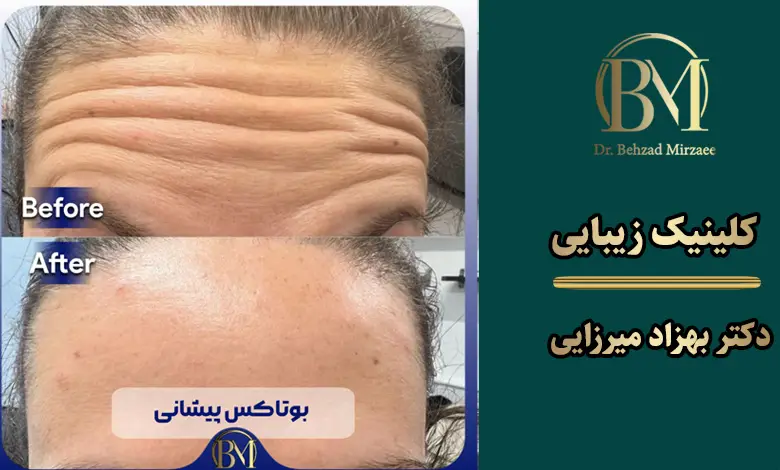 بهترین مرکز بوتاکس فردیس کرج ⭐【سال1404】 1 بهترین مرکز تزریق بوتاکس در فردیس