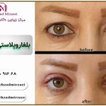 بهترین مرکز بلافاروپلاستی در فردیس (جراحی زیبایی پلک)