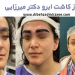 بهترین مرکز کاشت ابرو در فردیس