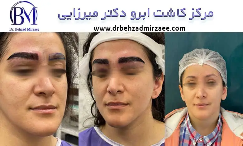 بهترین مرکز کاشت ابرو در فردیس 1 بهترین مرکز کاشت ابرو در فردیس