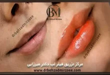 تزریق ژل لب در فردیس با بهترین برند و متدهای روز 2 تزریق ژل لب در فردیس
