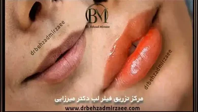 تزریق ژل لب در فردیس با بهترین برند و متدهای روز 3 تزریق ژل لب در فردیس