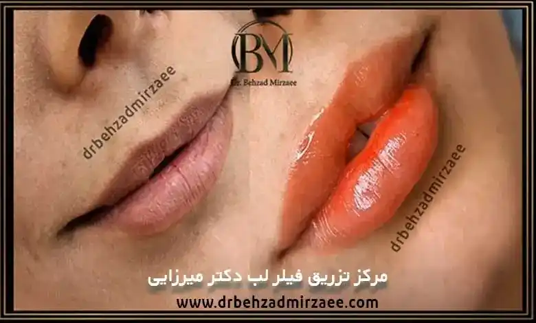 تزریق ژل لب در فردیس با بهترین برند و متدهای روز 1 تزریق ژل لب در فردیس