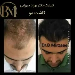 کاشت مو فردیس
