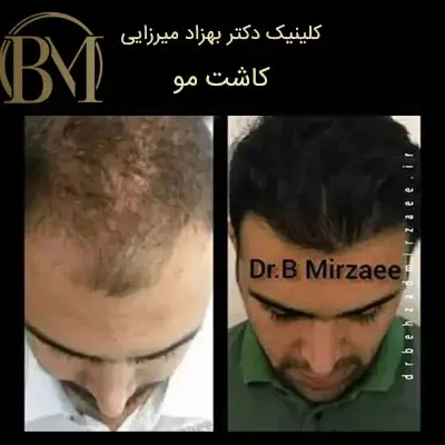 کلینیک زیبایی دکتر بهزاد میرزایی - زیبایی و جوانی 7 کاشت مو فردیس