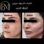 تزریق چربی فردیس