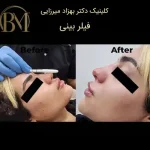 تزریق فیلر بینی فردیس