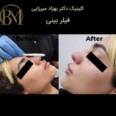 کلینیک زیبایی دکتر بهزاد میرزایی - زیبایی و جوانی 8 تزریق فیلر بینی فردیس