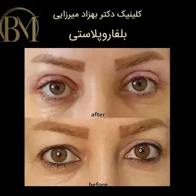 کلینیک زیبایی دکتر بهزاد میرزایی - زیبایی و جوانی 6 بلفاروپلاستی فردیس