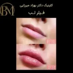 تزریق فیلر لب فردیس