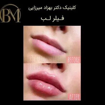 کلینیک زیبایی دکتر بهزاد میرزایی - زیبایی و جوانی 9 تزریق فیلر لب فردیس