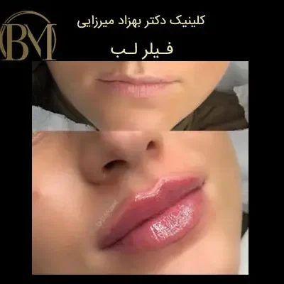 کلینیک زیبایی دکتر بهزاد میرزایی - زیبایی و جوانی 5 فیلر لب روسی فردیس