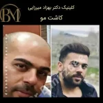 کاشت مو طبیعی فردیس