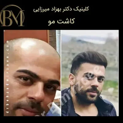 کلینیک زیبایی دکتر بهزاد میرزایی - زیبایی و جوانی 11 کاشت مو طبیعی فردیس