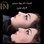 تزریق فیلر بینی فردیس