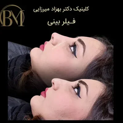 کلینیک زیبایی دکتر بهزاد میرزایی - زیبایی و جوانی 4 تزریق فیلر بینی فردیس